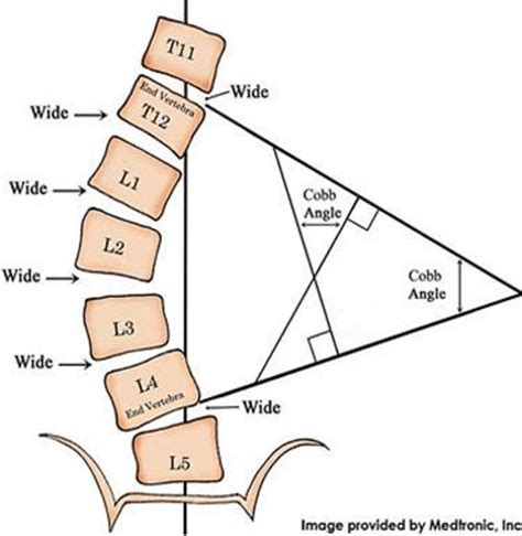 cobb angle measurement tool online